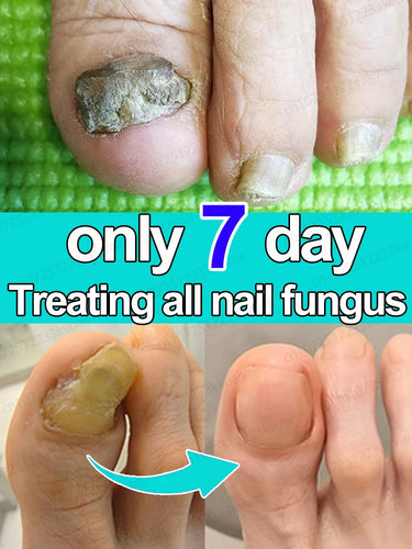 Nail fungus treatment essence oil